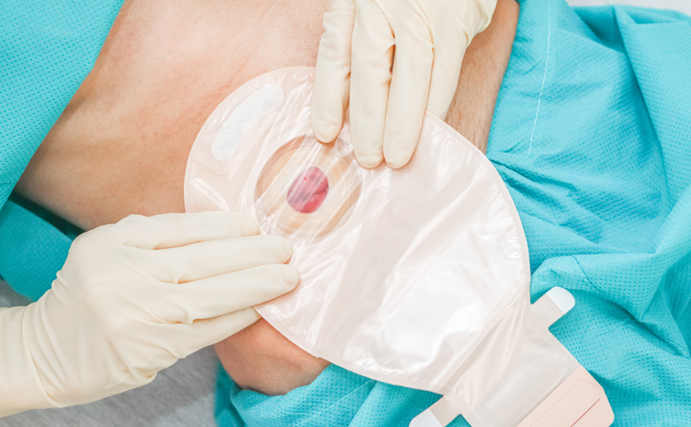 Capacitación en Domicilio Cuidados para Colostomía